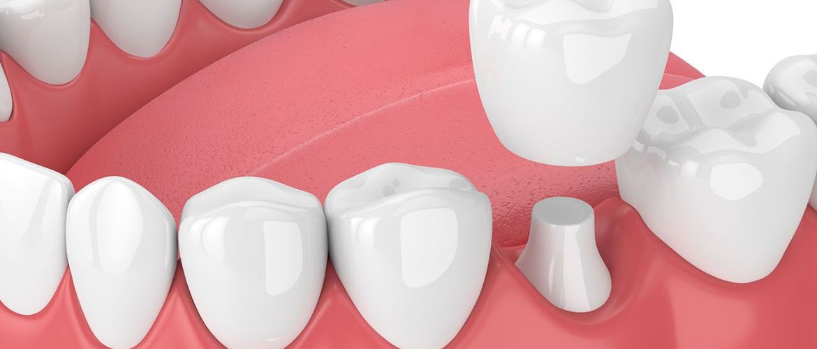 Dental Crowns Treatment in Bandra West