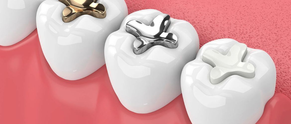 Dental Fillings Treatment in Bandra West