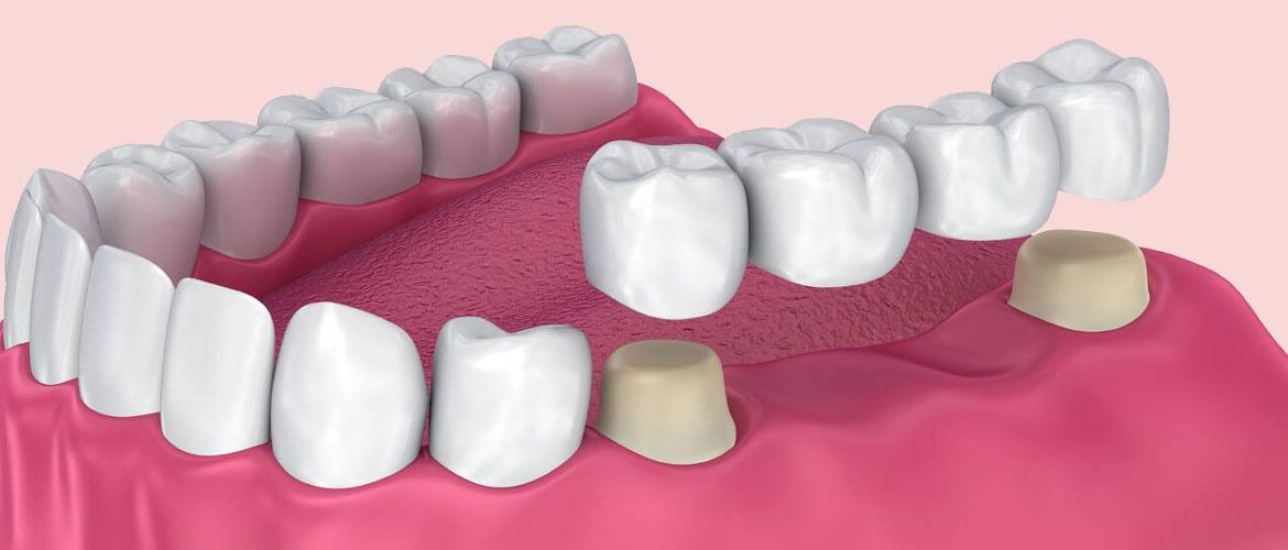 Dental bridges treatment in Bandra West