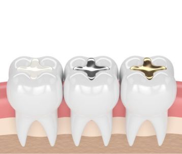 Dental fillings treatment in Bandra West