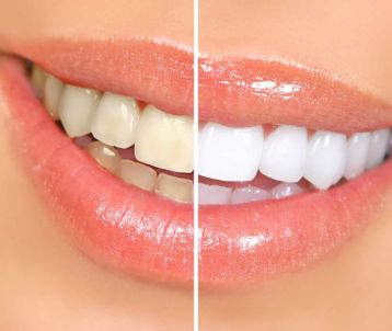 Teeth Whitening Treatment in Bandra West