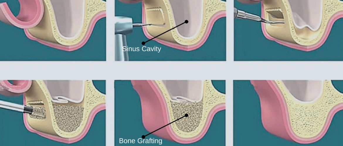 bone graft & sinus lift treatment in Bandra West