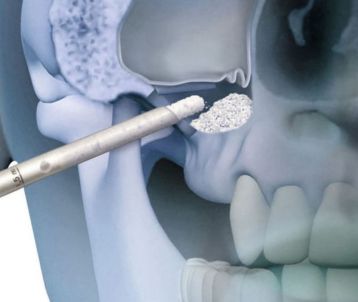 bone graft & sinus lift treatment in Bandra West