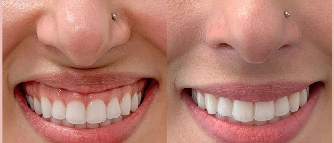 cosmetic gum surgery in Bandra West