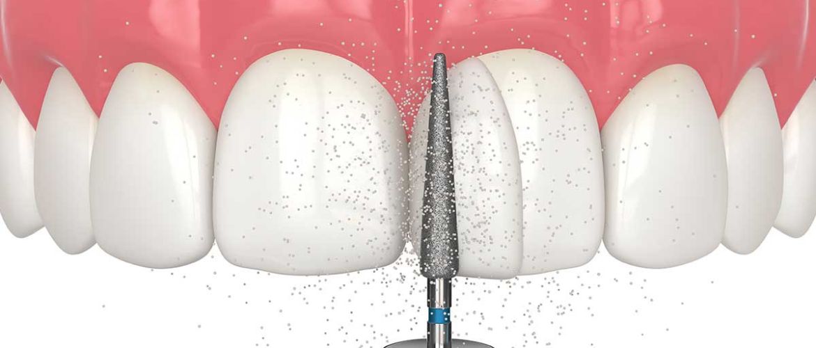 dental bonding treatment in Bandra West