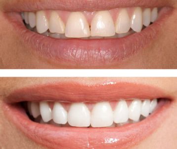 dental bonding treatment in Bandra West