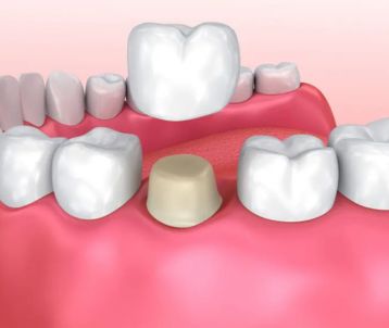 dental crowns treatment in Bandra West
