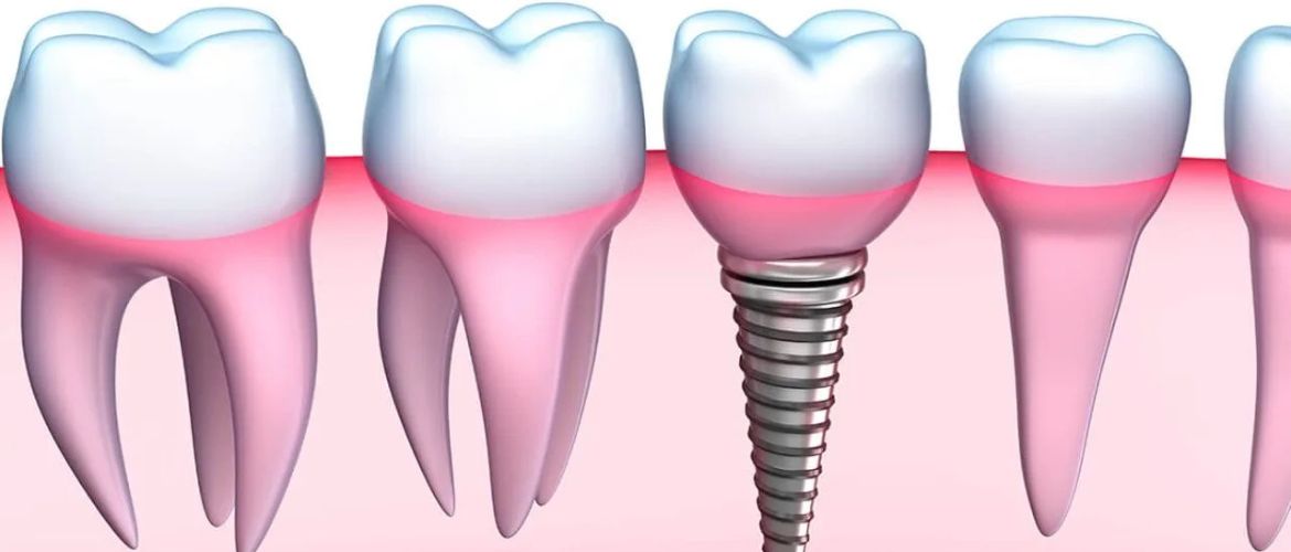 dental implants treatment in Bandra West