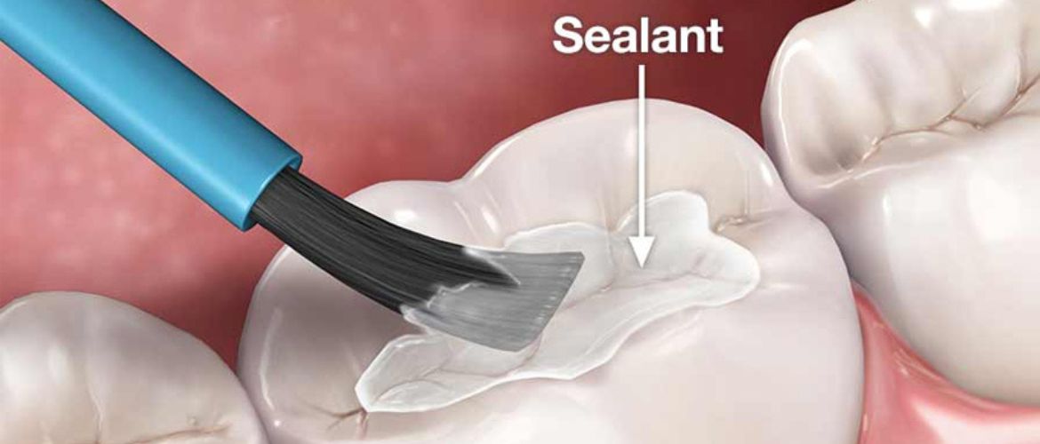 dental sealants treatment in Bandra West