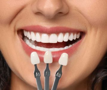 dental veneer treatment in Bandra West
