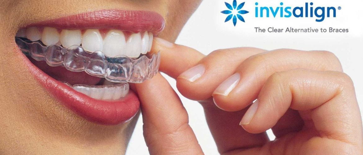 invisalign aligners treatment in Bandra West