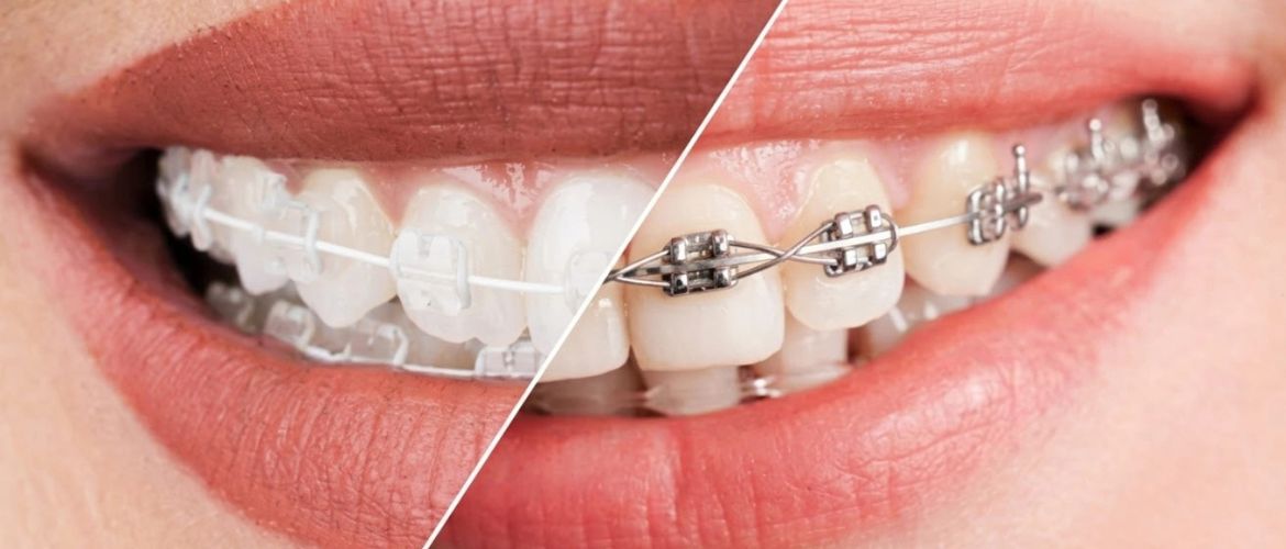 metal & ceramic braces treatment in Bandra West