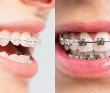 metal & ceramic braces treatment in Bandra West