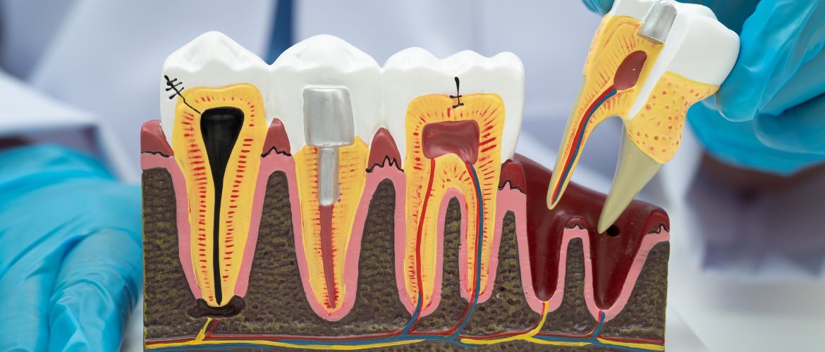 root canal treatment in Bandra West