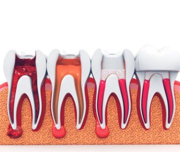 root canal treatment in Bandra West