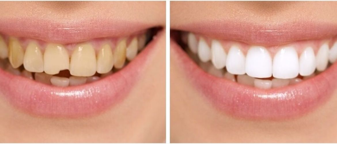 smile makeover treatment in Bandra West