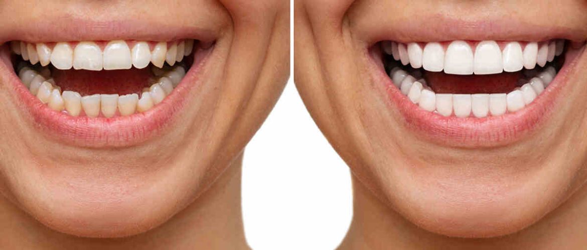 teeth reshaping treatment in Bandra West