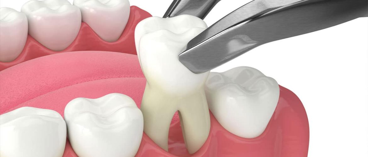 tooth extraction treatment in Bandra West