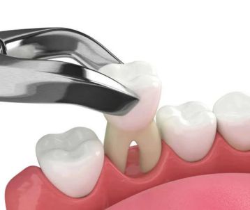 tooth extraction treatment in Bandra West